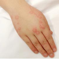 Urticaria Treatment