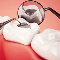 Dental Fillings