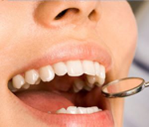 Teeth Filling Services