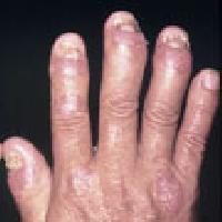 Rheumatoid Arthritis Treatment