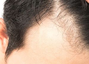 Alopecia Areata Treatment Services