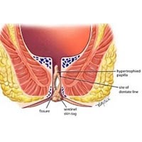 Fistula Treatment In Bangalore