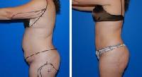 Liposuction Surgery In Mumbai