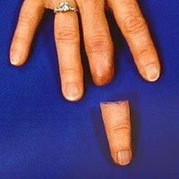 Artificial Fingers In Delhi