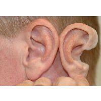 Silicone Ear Prosthesis In Delhi