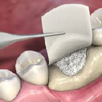 Collagen Bone Graft